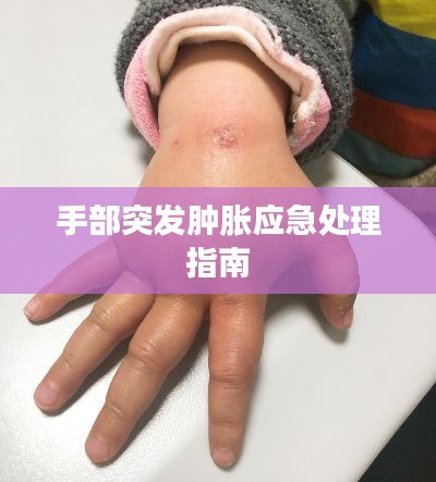 手部突发肿胀应急处理指南